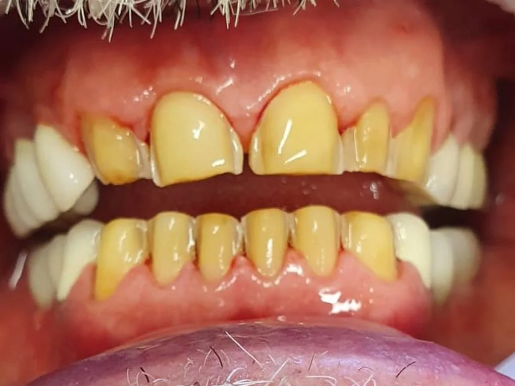 Dentes escurecidos e desgastados antes do tratamento