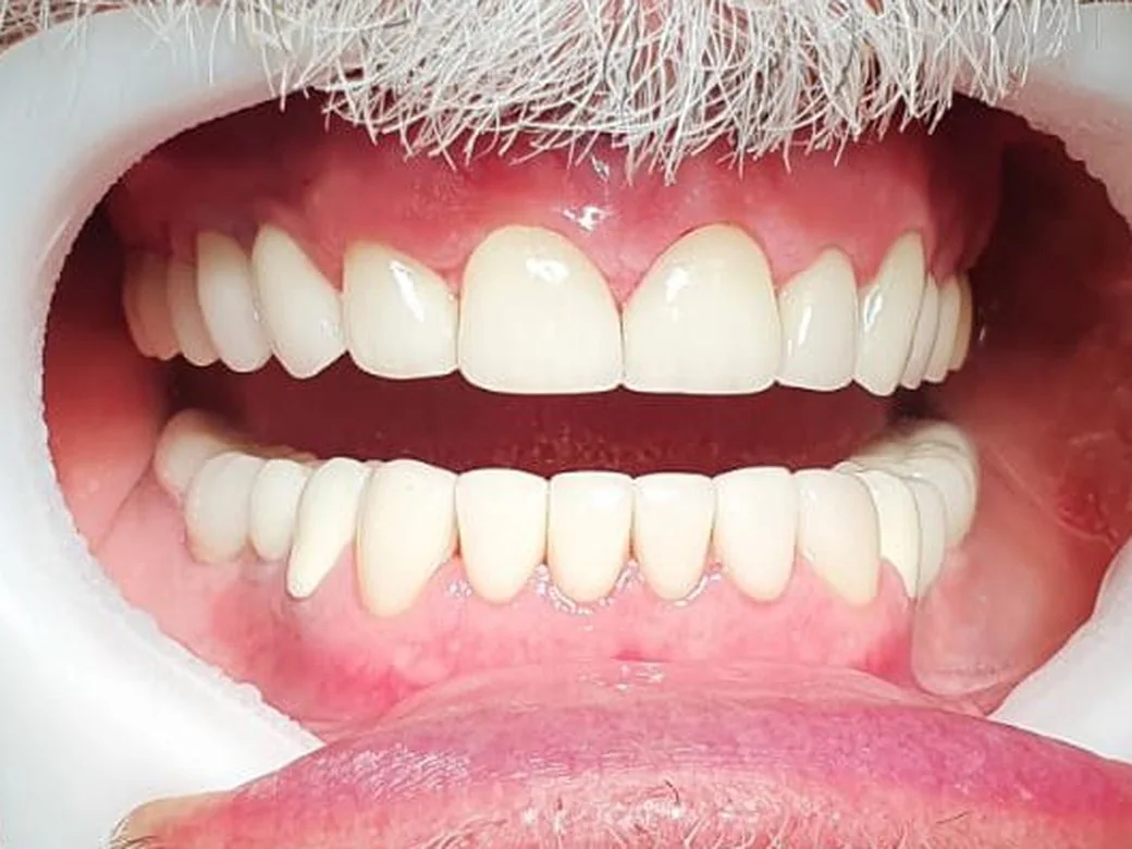 Mesmo paciente após a reabilitação, com dentes claros e alinhados