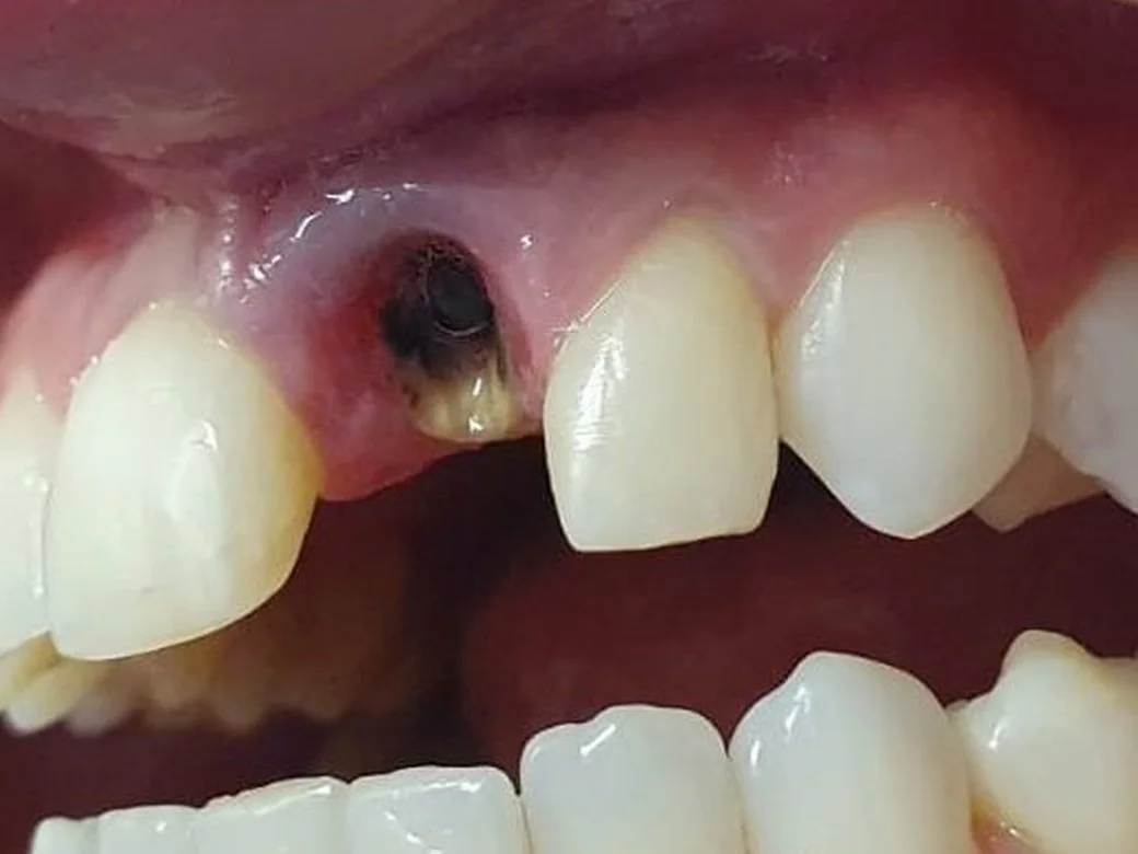 Ausência de dente anterior com implante exposto