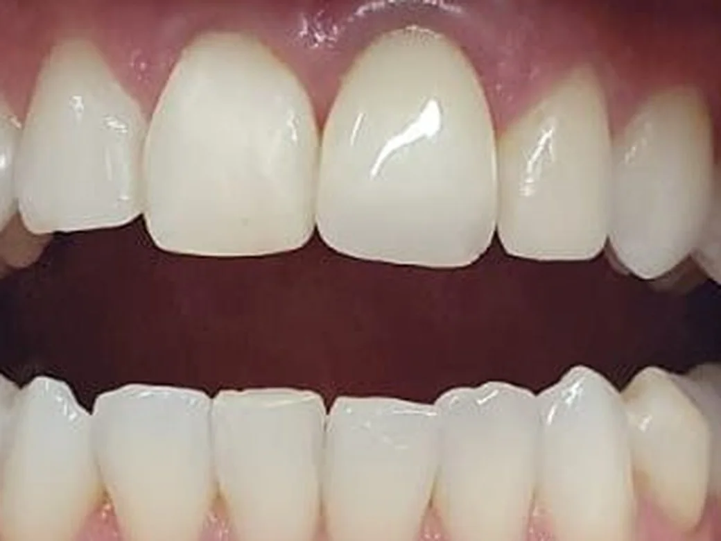 Dente reposto e integrado ao restante da arcada